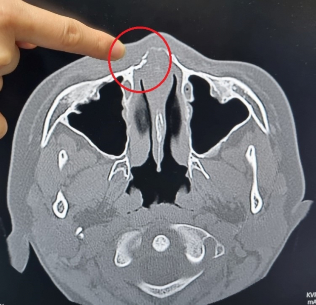 코뼈 골절 CT 촬영 사진. 피해 학생 부모 제공
