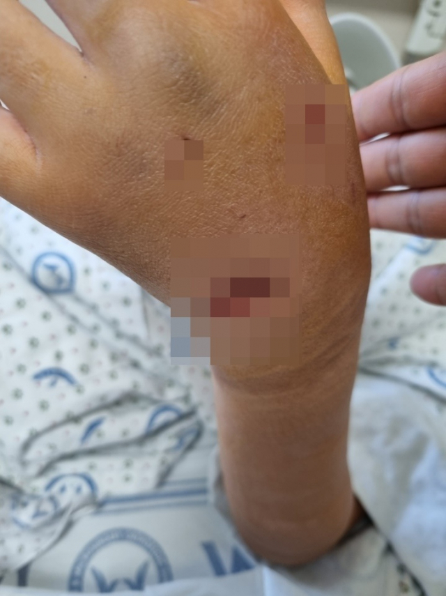 경남 합천군의 한 초등학교에서 개물림 사고가 발생했다. 피해 학생은 손과 배, 허벅지 등을 물려 병원에 입원했다. 피해 학생 학부모 제공