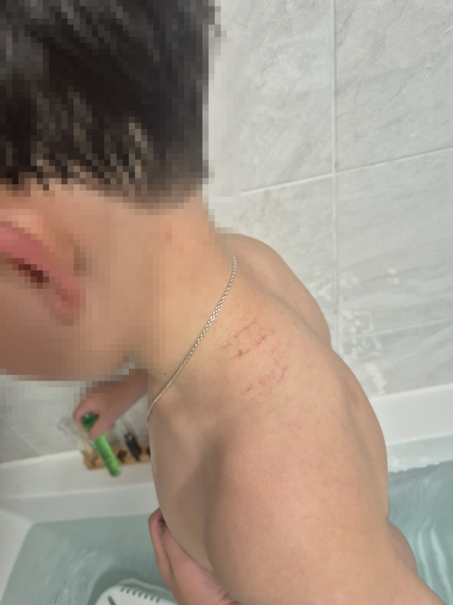 A유치원의 CCTV에서 교사가 B 군을 원통에 넣고 여러 차례 흔드는 모습이 확인됐다. B 군 학부모가 주장하는 당시 원통에 끼여 B 군 목에 생긴 상처. B 군 학부모 제공